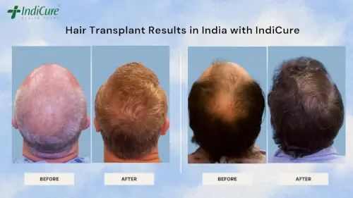 Hair Transplant Results in India with IndiCure